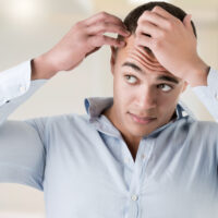 Male pattern baldness &#8211; Symptoms and treatments