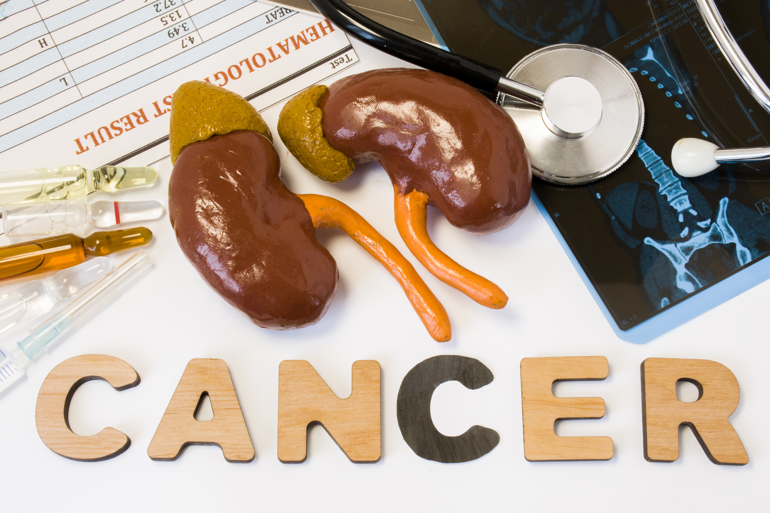 Stages of kidney cancer and treatment options one should know